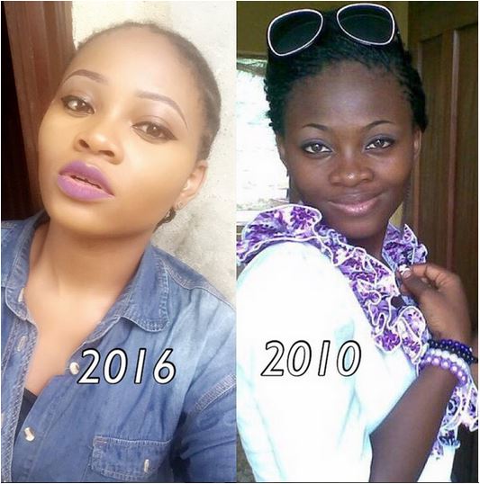 Bleaching Skin Before And After